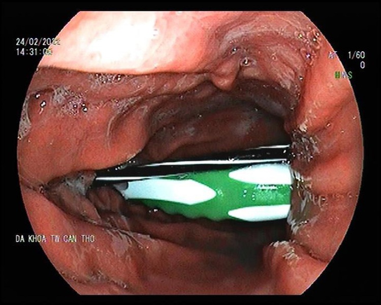 Vietnamese doctors remove large sharp objects from man's stomach