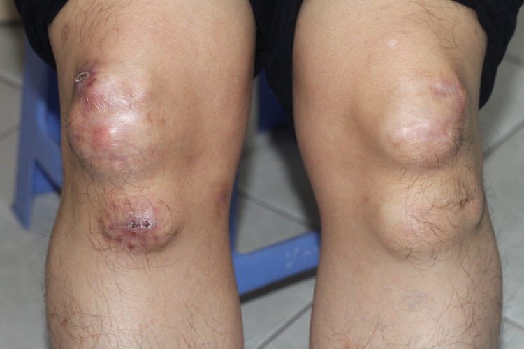 Ho Chi Minh City siblings found with world’s first reported gene mutation that causes random lumps