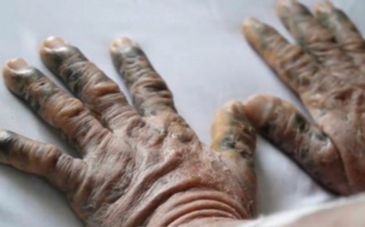 Vietnam doctors warn herbal medicine of unknown origin may cause poisoning
