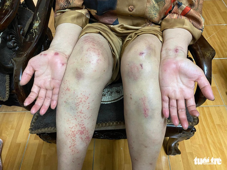 Vietnamese woman shares story after surviving week in wilderness