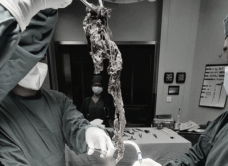 Children with bowel obstruction due to hair eating rise in Ho Chi Minh City