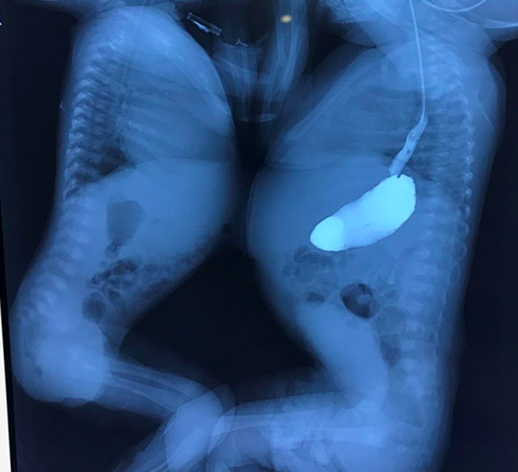 Vietnamese conjoined twins share liver, one in critical condition