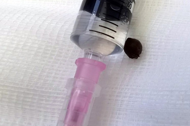 Vietnamese doctors remove pepper grain stuck in man’s lung for 7 years