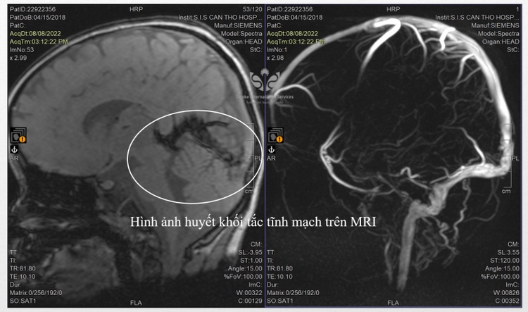Doctors save 4-year-old boy from brain stroke in Vietnam’s Mekong Delta