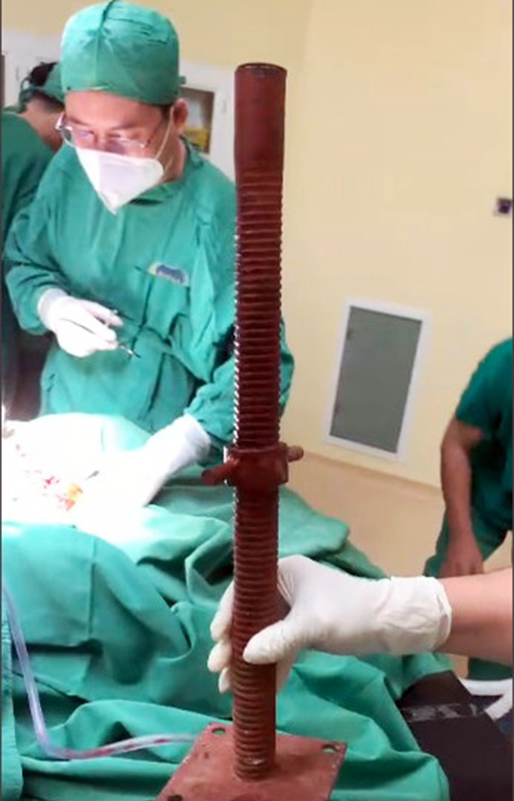 Vietnamese doctors save construction worker with iron bar piercing through neck