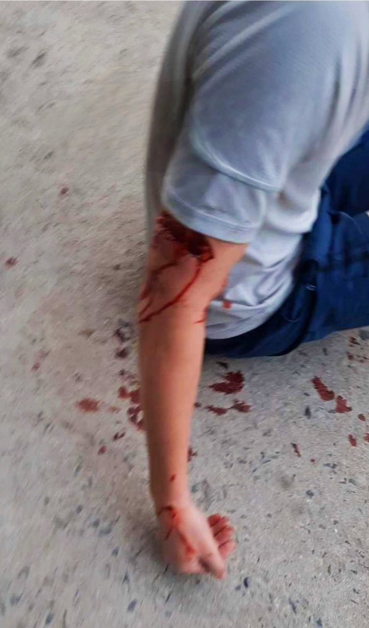 Foreign tourist hospitalized after dog attack in Vietnam’s Nha Trang