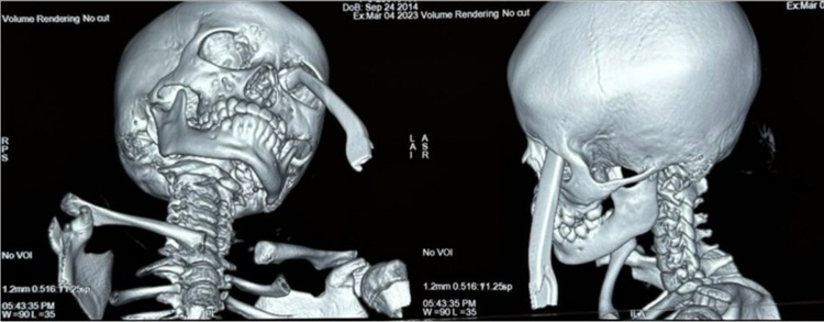 Ho Chi Minh City doctors save girl with hand brake piercing eye socket, skull base