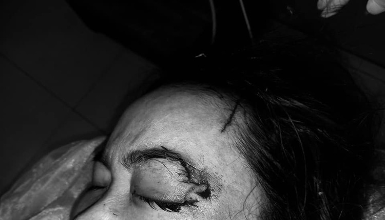 Woman suffers serious eye injury in dog attack in northern Vietnam