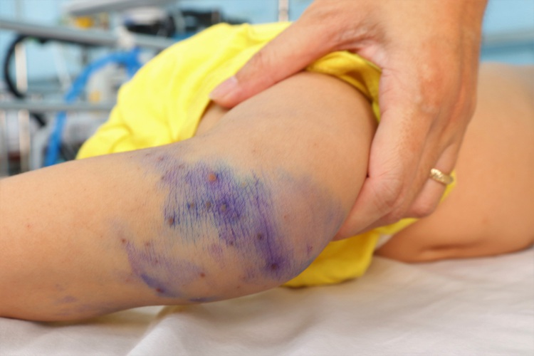 5-year-old child dies of suspected HFMD in Ho Chi Minh City