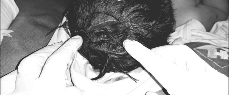 Dog bites 18-month-old, exposes skull in northern Vietnam