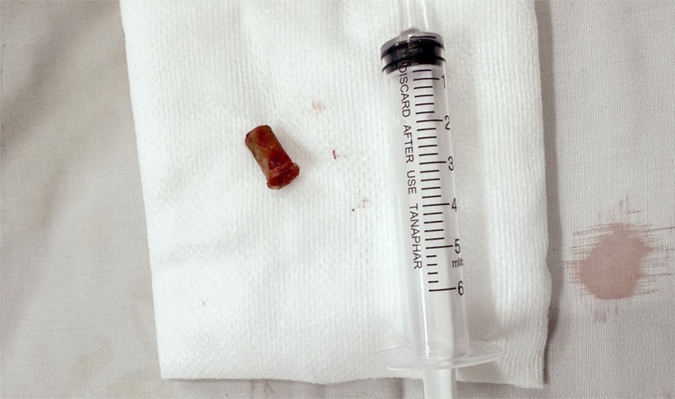 Ho Chi Minh City doctors remove shoe squeaker left 7 years in 15-year-old’s lung