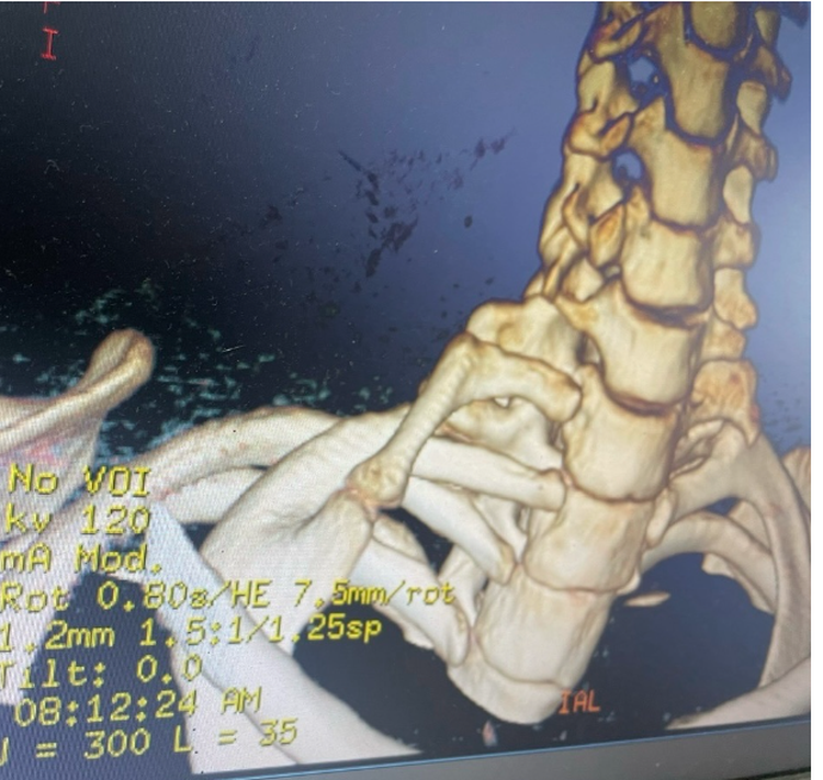 Rare condition: Vietnamese woman develops rib in neck