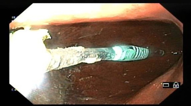Toothbrush removed from Vietnamese woman’s stomach