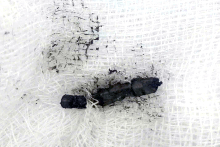 Doctors remove 27 magnets from intestines, stomach of 2-year-old in Vietnam