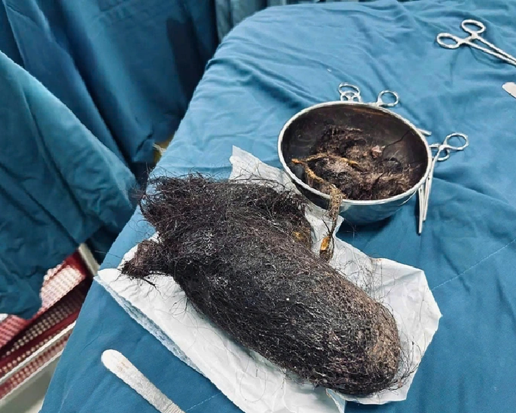 900gr hairball removed from 12-year-old Vietnamese girl’s stomach