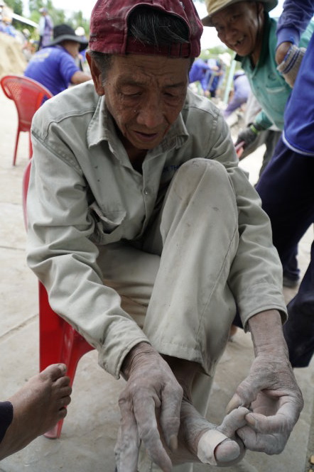 Huynh Phu Chien, 75, shows his injured foot at a construction site in Dong Thap Province, southern Vietnam. Photo: Tuoi Tre