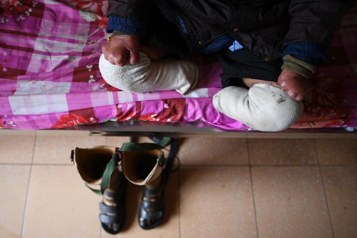 A disabled leprosy survivor sits on his bed at Van Mon Leprosy Hospice. Photo: AFP
