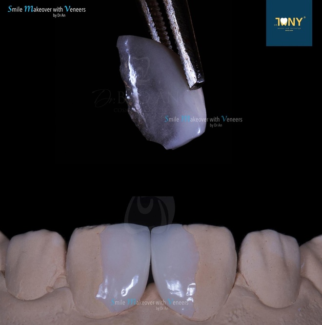 Veneers of only 0.2-0.5 millimeters in thickness preserve the original teeth structure and provide a natural look.
