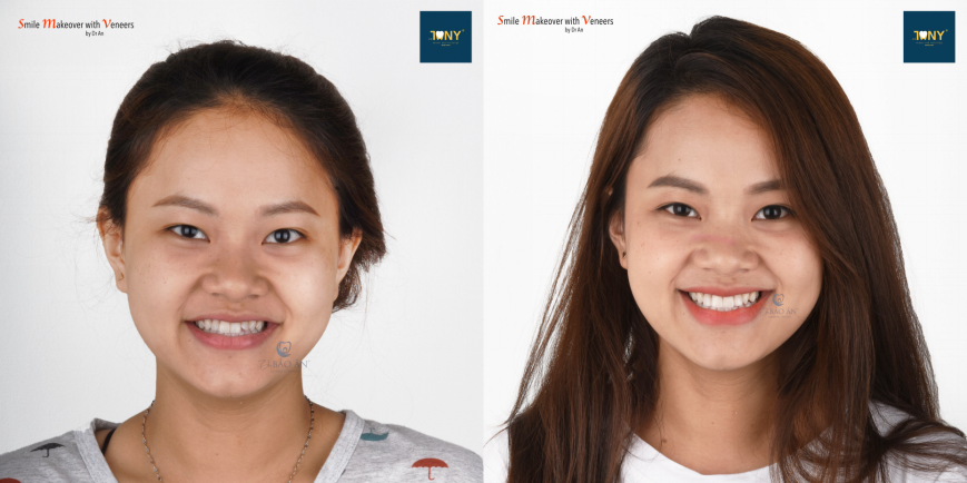 Veneers improve teeth appearance and give customers a more radiant smile.