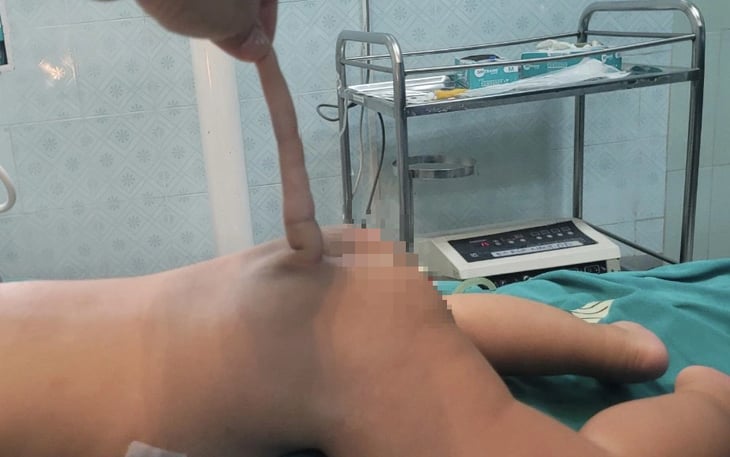 The four-month-old child with a rare ‘human tail’ in Thanh Hoa Province, north-central Vietnam. Photo: Supplied