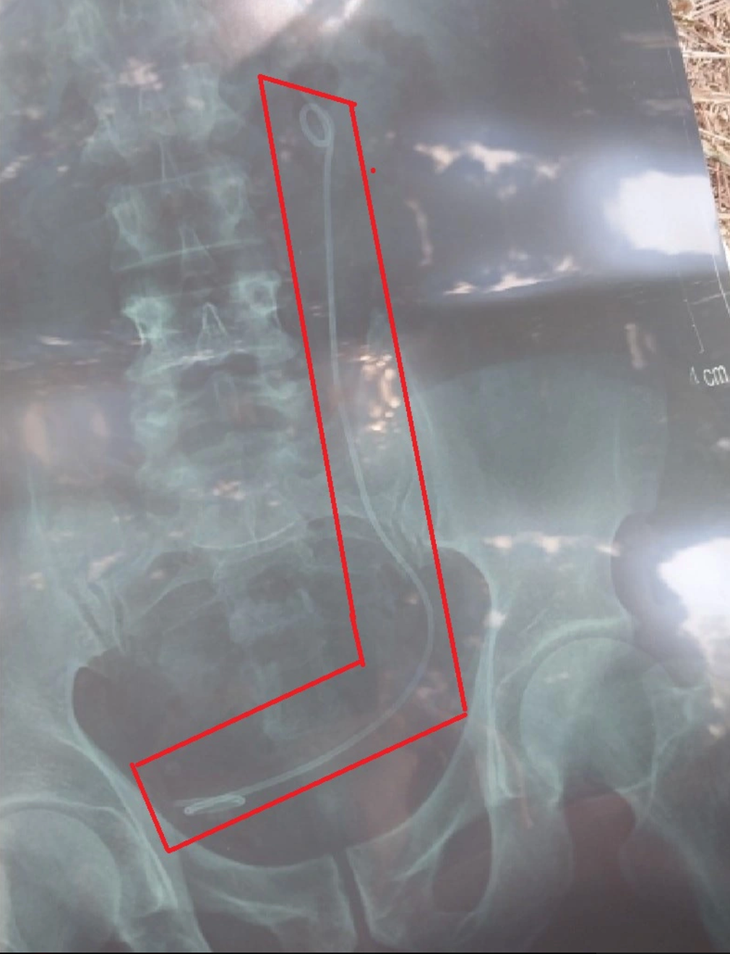 The X-ray scan result that the Lam Dong General Hospital mistakenly gave to N.H.H., who wrongly underwent a surgery. Photo: T.A. / Tuoi Tre