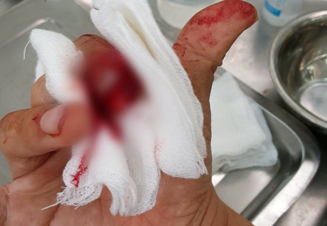 Một ngón tay trên bàn tay phải của nàh báo Đỗ Doãn Hoàng bị những người lạ mặt dùng gậy đập làm cho bật móng, đầu ngón tay bị dập - Ảnh: Báo Lao động cung cấp