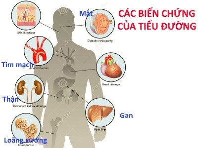 Các biến chứng nguy hiểu của tiểu đường - Ảnh: Internet