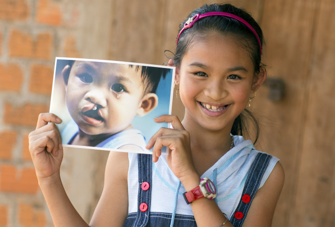 Bé Ngân sinh năm 2001, quê quán Gia Lai, là một trong những bệnh nhân từng tham gia chương trình phẫu thuật Operation Smile