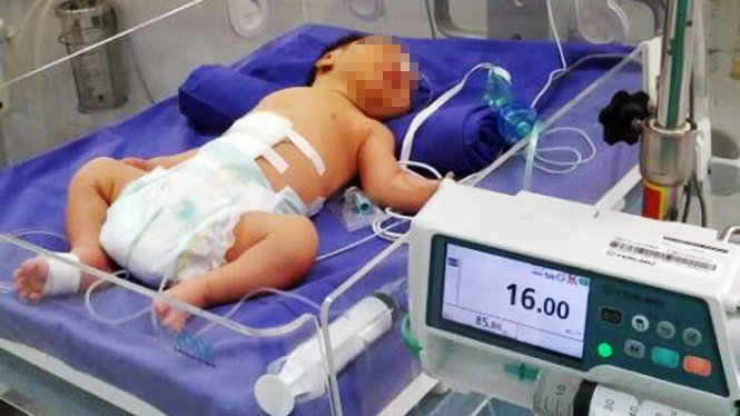 Bé V được chăm sóc sau ca mổ - Ảnh: Bệnh viện Sản nhi Quảng Ninh cung cấp