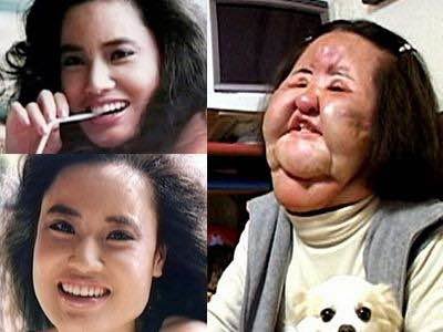 Hang Mioku là một ví dụ về nghiện thẩm mỹ và thất bại trong thẩm mỹ điển hình nhất ở Hàn Quốc - Ảnh: Daily Mail