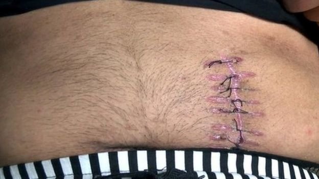 Buôn tạng bất hợp pháp diễn ra tại các nước có nhiều người nghèo khó - Ảnh: BBC