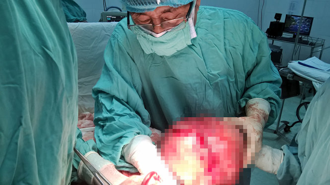 Khối u to đã được các bác sĩ lấy ra khỏi cơ thể bệnh nhân - Ảnh do Bệnh viện Trung ương Huế cung cấp