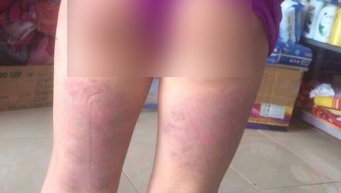 Vết thương bầm tím ở vùng mông đến ngót chân của M. sau khi bị cô giáo dùng thước đánh - Ảnh: TRUNG NGUYỄN