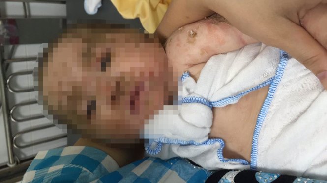 ​Bé 4 tháng bị nhiễm trùng, nhiễm độc vì tắm nước lá - Ảnh: Thuý Anh