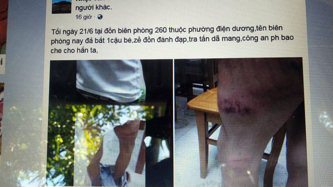 Đoạn clip và những hình ảnh vết bầm tím trên người Trúc được anh trai đăng lên Facebook đã được hàng nghìn lượt chia sẻ và cả trăm lượt xem, bình luận - Ảnh: THANH BA