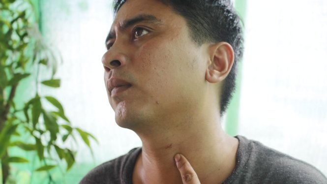 Anh Nguyễn Văn Hòa chỉ vết thương ở cổ anh và cho rằng bị trưởng công an xã Tích Thiện bẻ cổ gây nên - Ảnh: HẠNH NGUYỄN