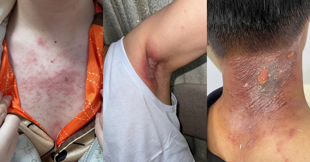 Kiến ba khoang 'vào mùa', cẩn trọng nhầm tổn thương da với zona thần kinh