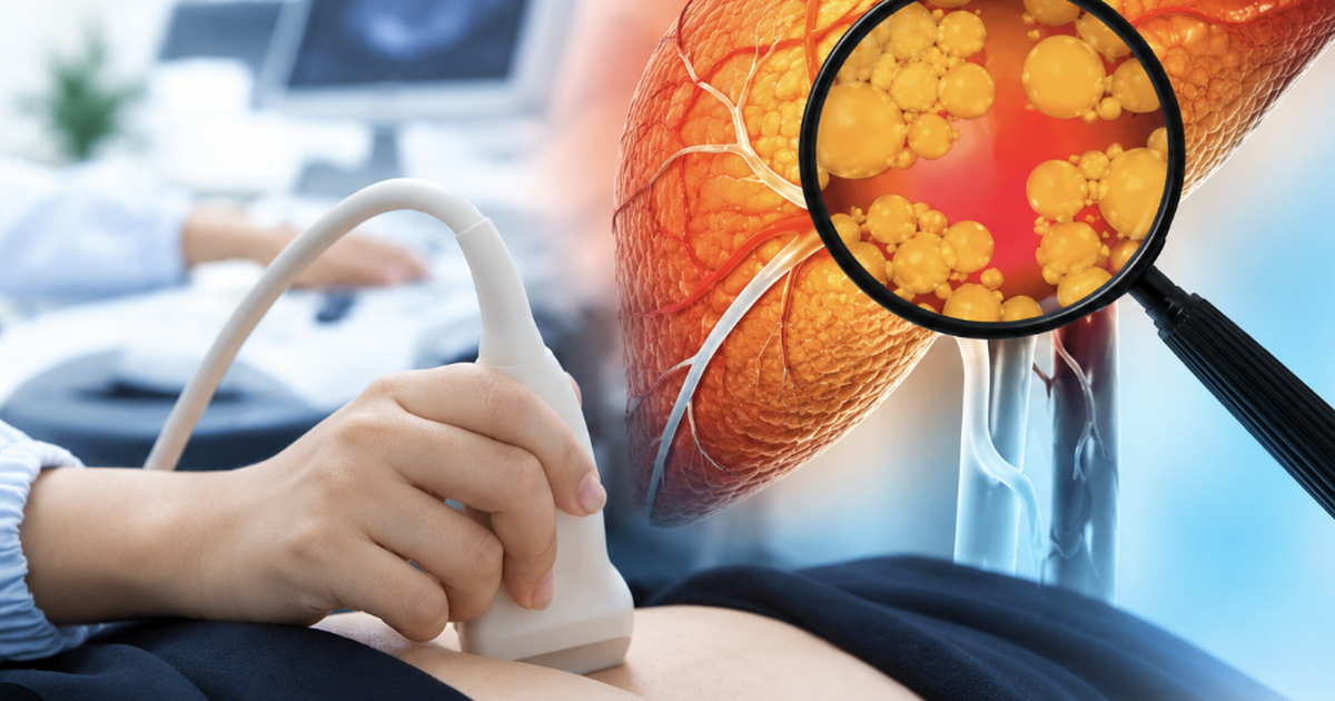Tập thể thao, ít rượu bia vẫn bị gan nhiễm mỡ vì thói quen tưởng chừng lành mạnh