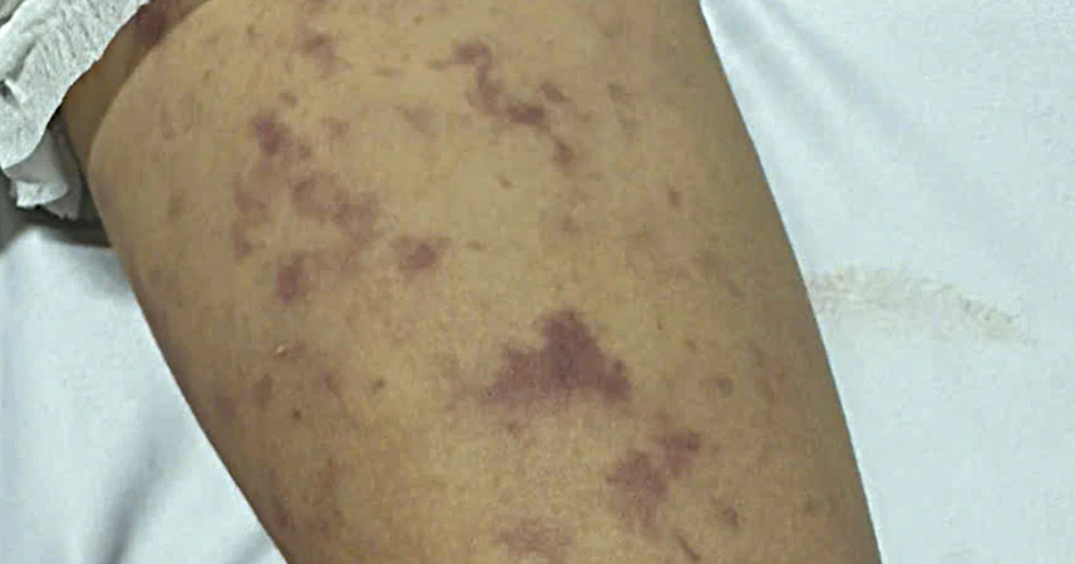 Xã Thường Tân, TP.HCM thông báo ghi nhận ca mắc não mô cầu ở trẻ 12 tuổi