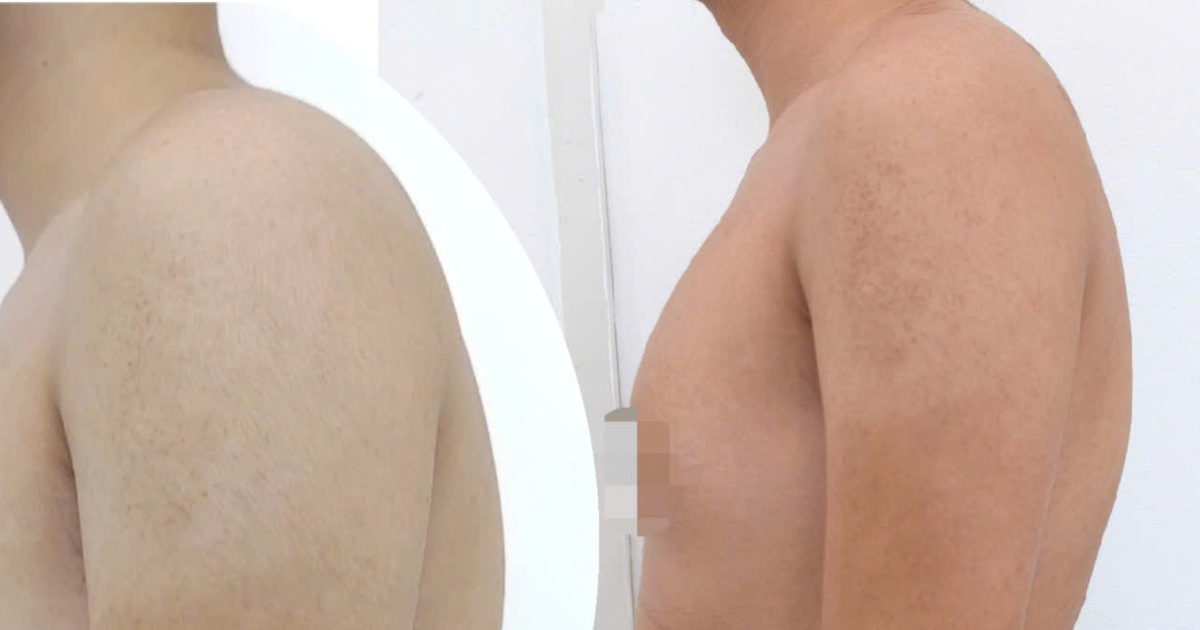 Cổ rụt, lưng gù vì ngồi vẹo vọ, bò dài trên bàn: Chữa thế nào?