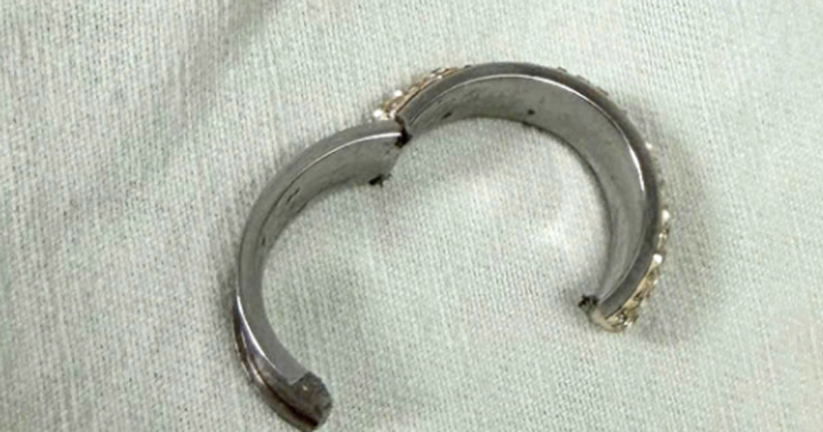 Cấp cứu nam thanh niên bị thắt nghẹt dương vật do đeo 'cock ring'