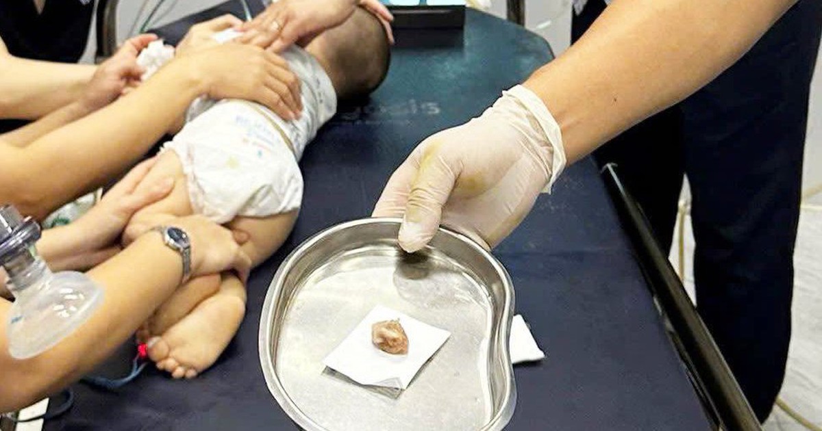 Bé trai 16 tháng tuổi tím tái, suy hô hấp vì hóc hạt chôm chôm