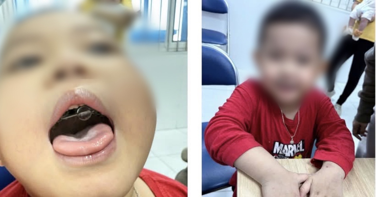 Ngưng thở khi ngủ kéo dài, bé trai tím tái cả khi thức suốt 2 năm