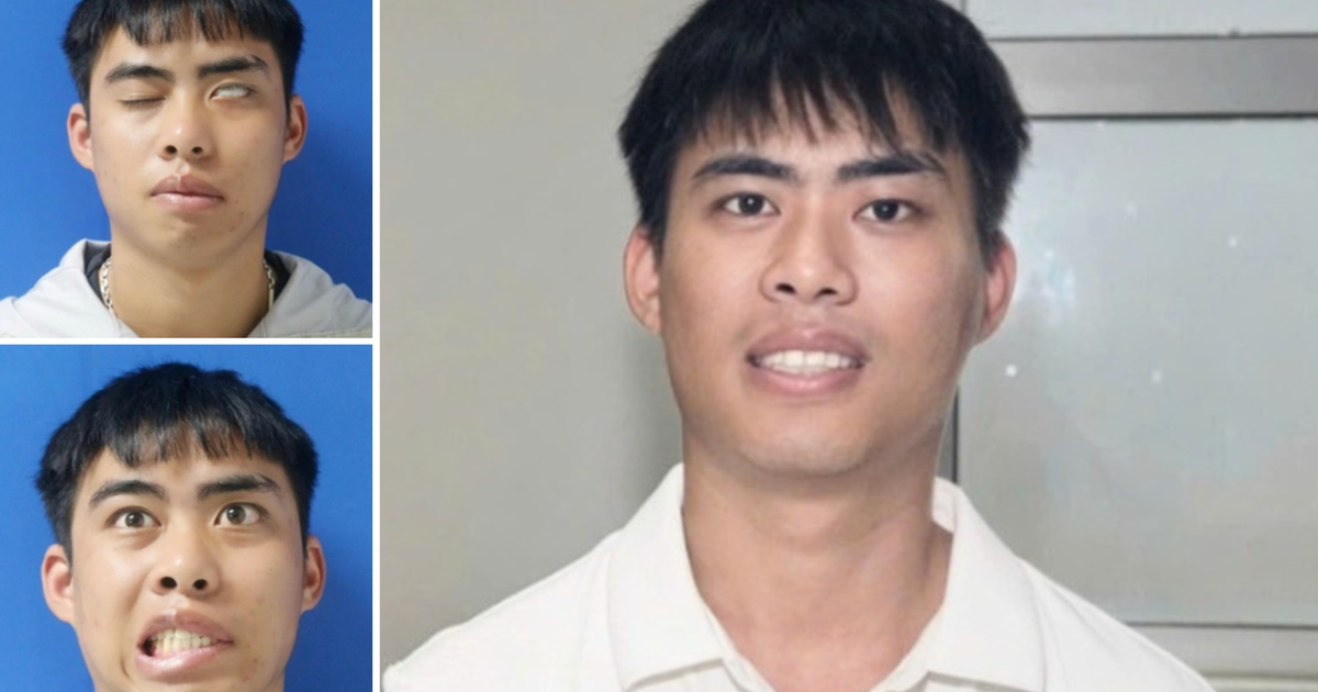 Phục hồi thành công gương mặt cho nam thanh niên liệt mặt suốt 7 năm