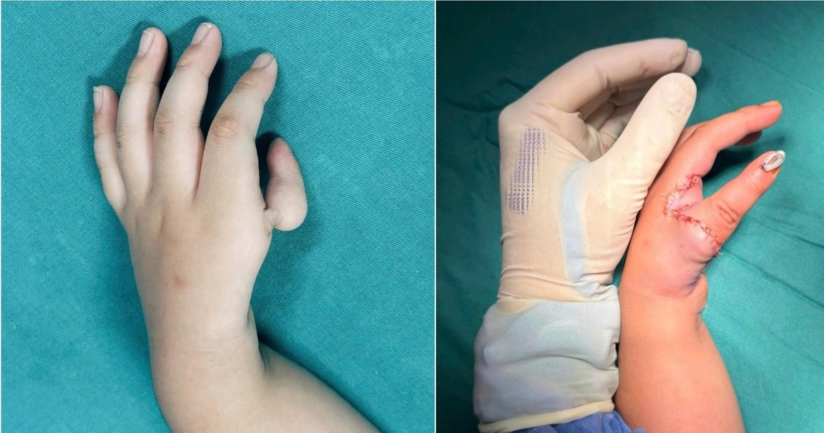 Bé gái được ‘tạo ngón cái mới’ từ ngón trỏ