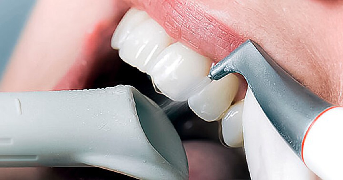 Vệ sinh răng sứ đúng cách để sau phục hình răng đảm bảo bền đẹp lâu dài