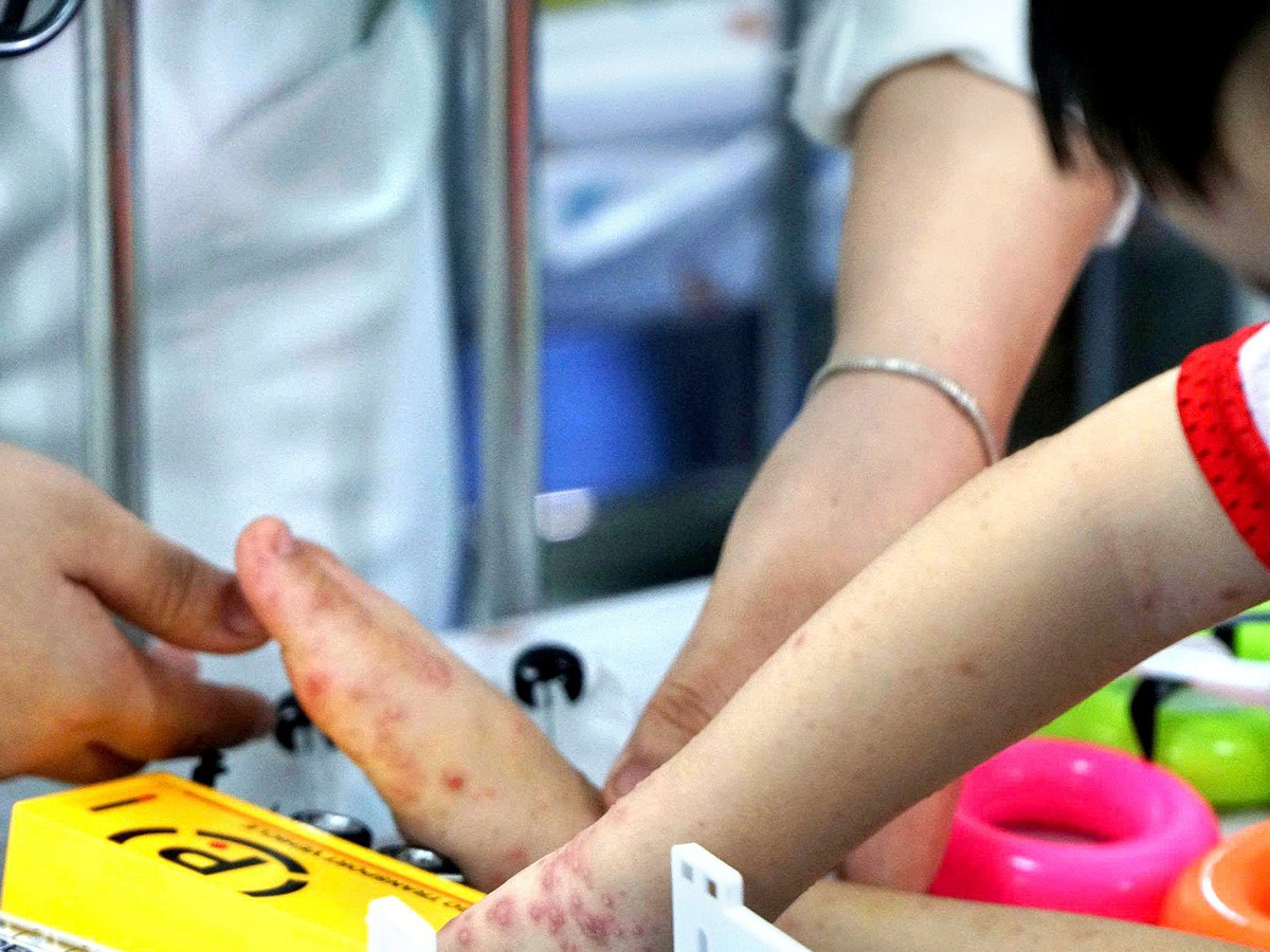 Ho Chi Minh City records over 42,000 hand, foot, mouth disease cases