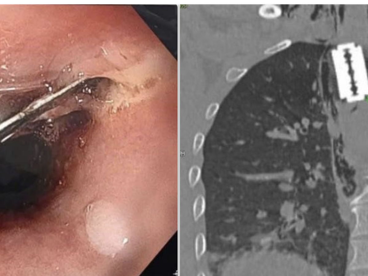 In Vietnam, man swallows razor blade while eating instant noodles