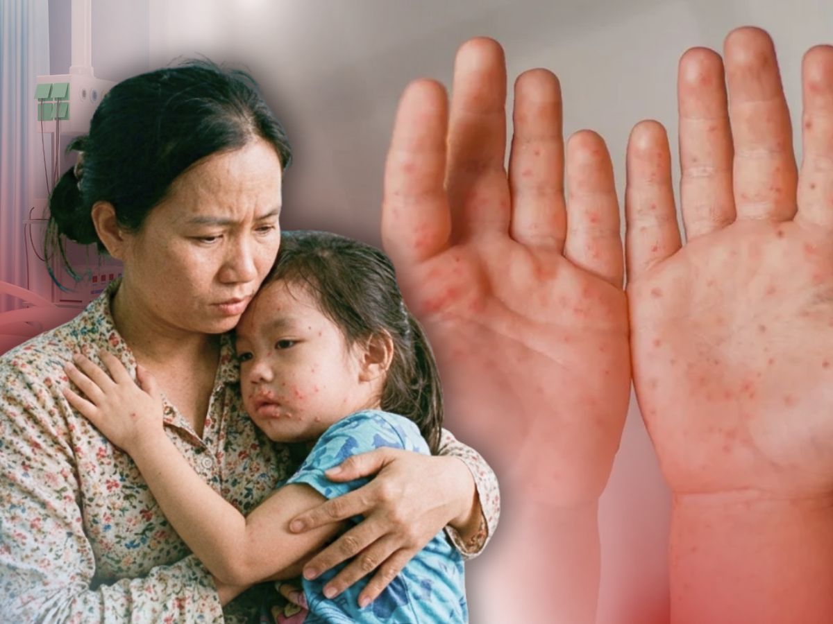 3 common childhood illnesses rise during hot season in Vietnam