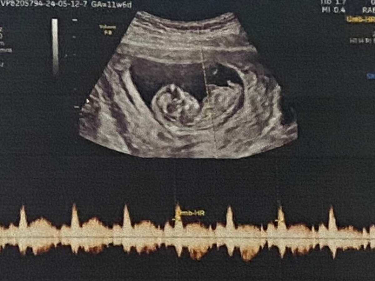 Vietnam to levy higher fine of up to $570 for revealing fetal sex from May 15